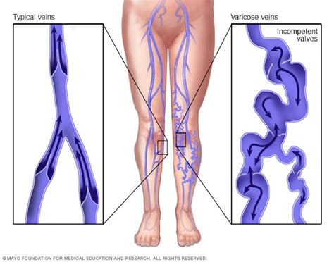 Vein Diseases & Varicose Veins - Treatment & Prevention – Dr. Segal's ...