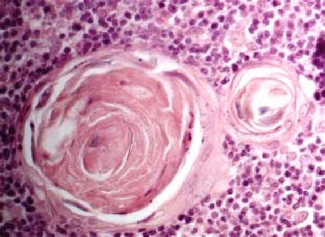 Thymic medulla with large cystic Hassall s corpuscle of a six-month-old ...