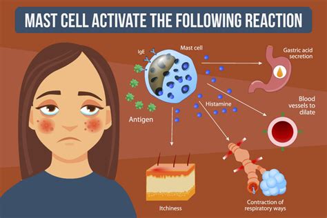 Mast Cell Activation Syndrome (MCAS) - Lifecode Gx Support