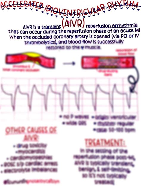 Accelerated Idioventricular Rhythm AIVR - Etsy