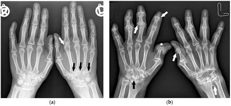 Rheumatoid Arthritis Hands X Ray