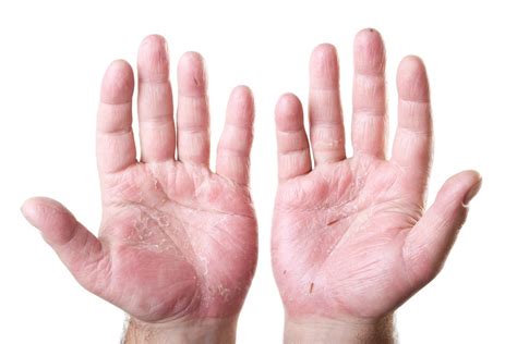 Hand Eczema: Causes, Symptoms and Treatment Options