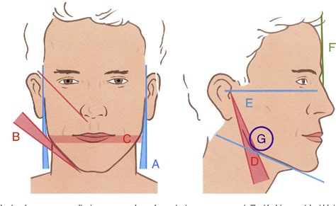 Figure 10 from The ideal male jaw angle--An Internet survey. - Semantic ...