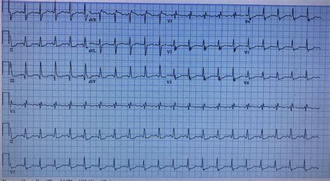 Ecg Changes In Pulmonary Embolism • Litfl • Ecg Library CB9