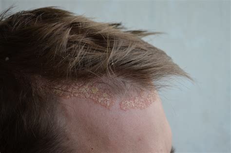 scalp psoriasis forehead hairline - Psoriasis Cure Now