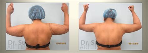 Arm Liposuction Before and After Results Large