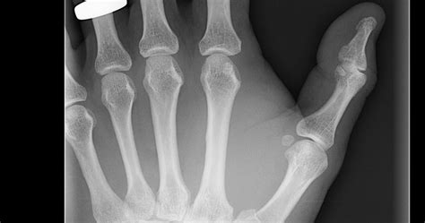 Radiology Cases: Bennett Fracture