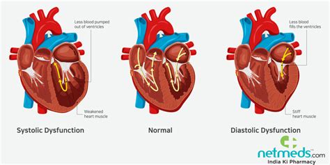 Heart Failure Symptoms, Causes, Types and Treatment