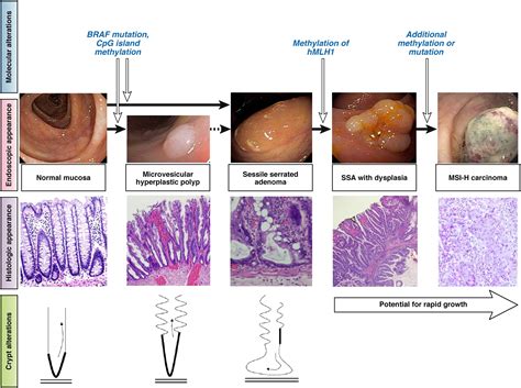 What to do About Sessile Serrated Adenomas – AGA Journals Blog