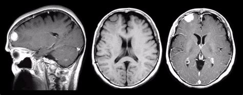 Meningioma