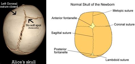 Alice in Cranioland | Skull, Sutures, Baby head