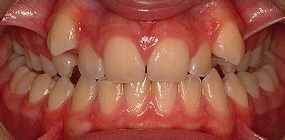 Posterior crossbite – detailed – Page 4 – the ortho guide