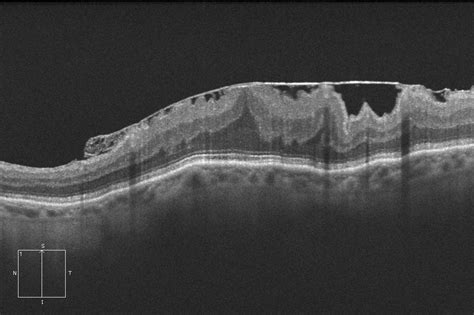 Epiretinal Membrane Oct