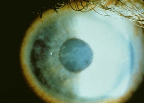 Treatment of Epithelial Basement Membrane Dystrophy With Manual ...