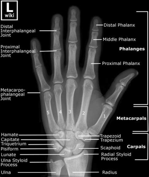 Frontal radiograph of the hand with labels. | Radiology student ...