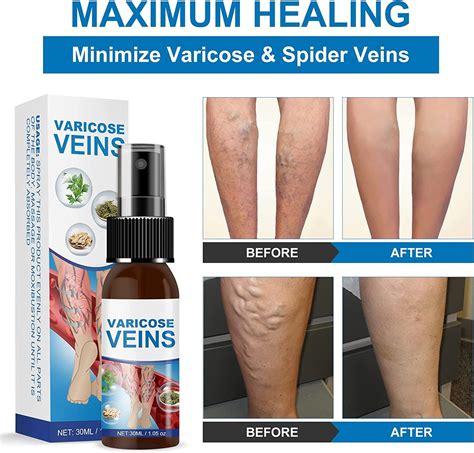 Varicose Veins Miracle Spray: Treatment for Legs to Improve Blood ...