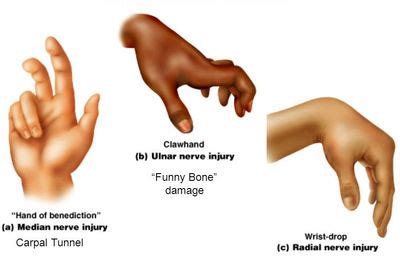 Ulnar Nerve Hand Deformity