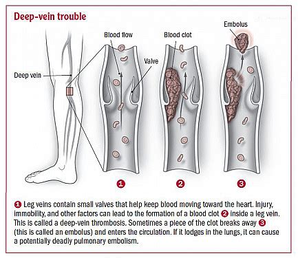 Blood Clot In Leg Ultrasound