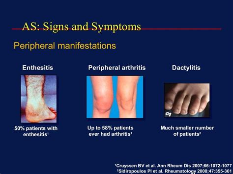 Inflammatory arthritis an overview