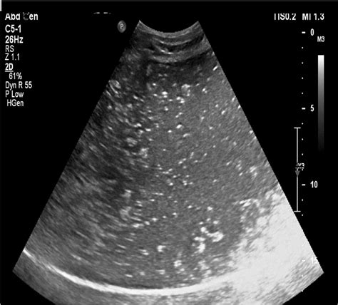 Ultrasound Of The Abdomen