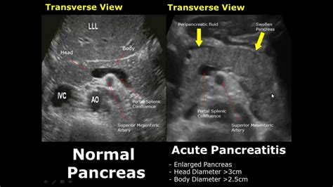 Pancreas Ultrasound