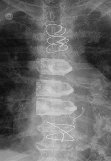 MRI safety: sternal wires - Questions and Answers in MRI