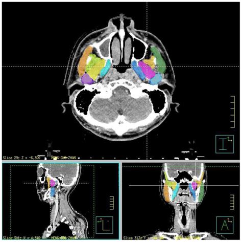 Lateral Pterygoid Muscle