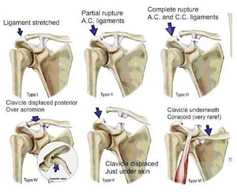 Pictures Of Acromioclavicular Joint