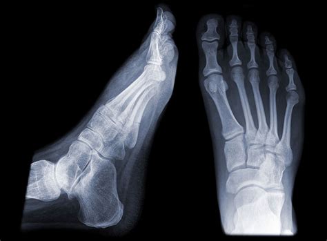 X Ray Foot Normal