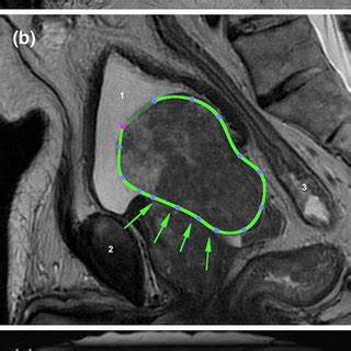 Typology of intravesical prostatic protrusions, or so-called median ...