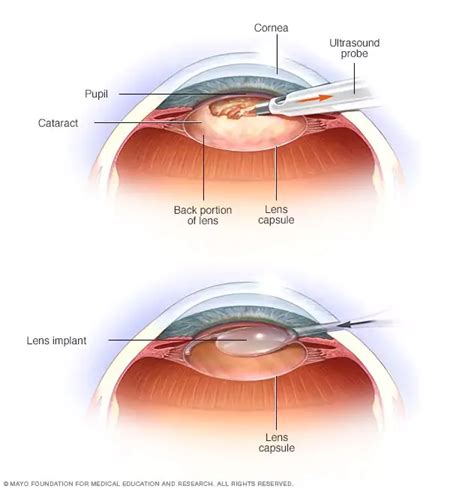 Glaucoma vs. Cataracts: What’s the Difference? - Responsum Health