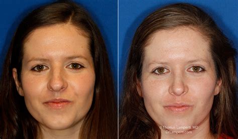 Bulbous/rounded tip | Rhinoplasty in Seattle | Rhinoplasty Surgeon