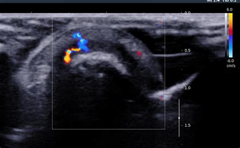 VIETNAMESE MEDIC ULTRASOUND: CASE 503: SUBUNGUAL GLOMUS TUMOR, Dr LÝ ...