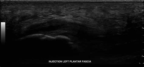 Plantar Fascia Tear Ultrasound