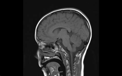 MRI Image: Saggital T1 image showing hypoplasia of the inferior ...