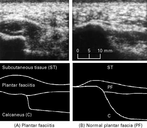 Ultrasound guided injection of recalcitrant plantar fasciitis | Annals ...