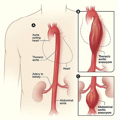 Aortic Aneurysm - Abdominal & Thoracic - Causes, Symptoms, Repair