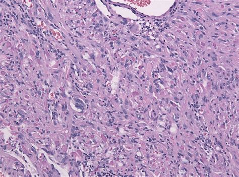 Pilocytic astrocytoma