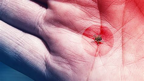 Tick Bite Symptoms You Need to Watch Out For This Summer | Tick bite ...