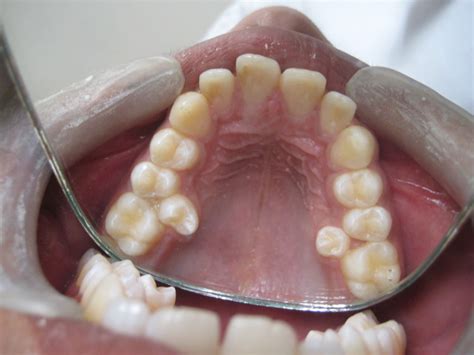 Rare combination of paramolar and distomolar supernumerary teeth in a ...