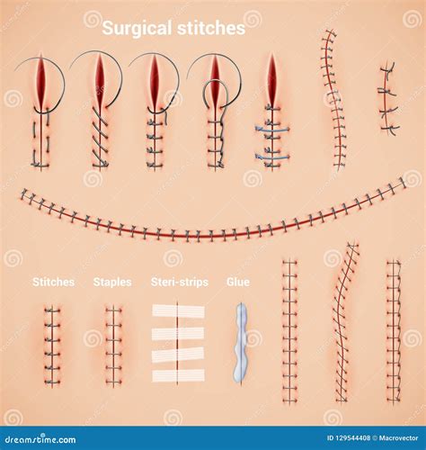 Surgical Stitches Infographic Set Stock Vector - Illustration of ...