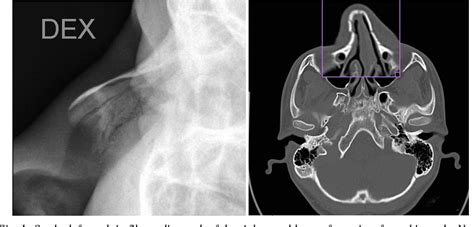 Nasal Fracture X Ray