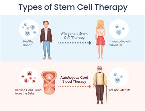 Stem cell therapy explained - Securicord