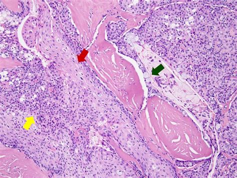 Mucoepidermoid Carcinoma Histology