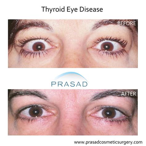 Thyroid Eye Disease Surgery/ Graves Eye Disease Surgery | Dr. Prasad