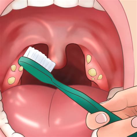 11 Tips How To Get Rid of Tonsil Stones At Home Fast