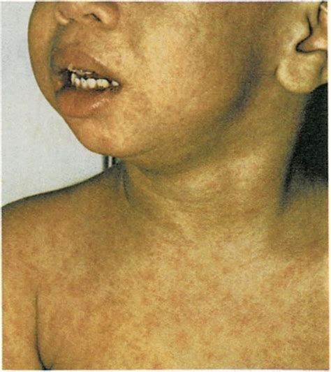 Measles, Rash, Sepsis, Sinusitis, Heart murmur, Deafness, Dream ...