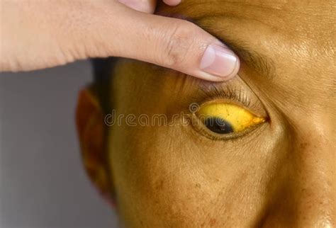 Deep Jaundice in Asian Male Patient. Yellowish Discoloration of Skin ...