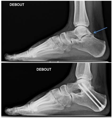 Arthrodesis – Foot and Ankle Institute