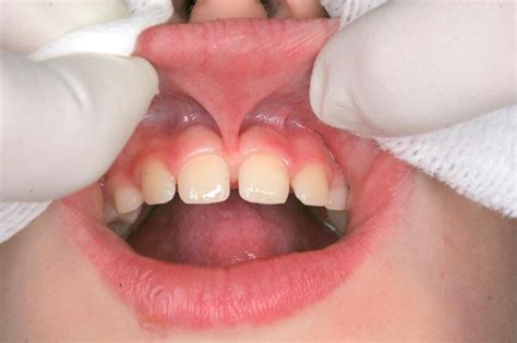 Abnormal Frenum Attachments In Children | Homeopathic Dentistry